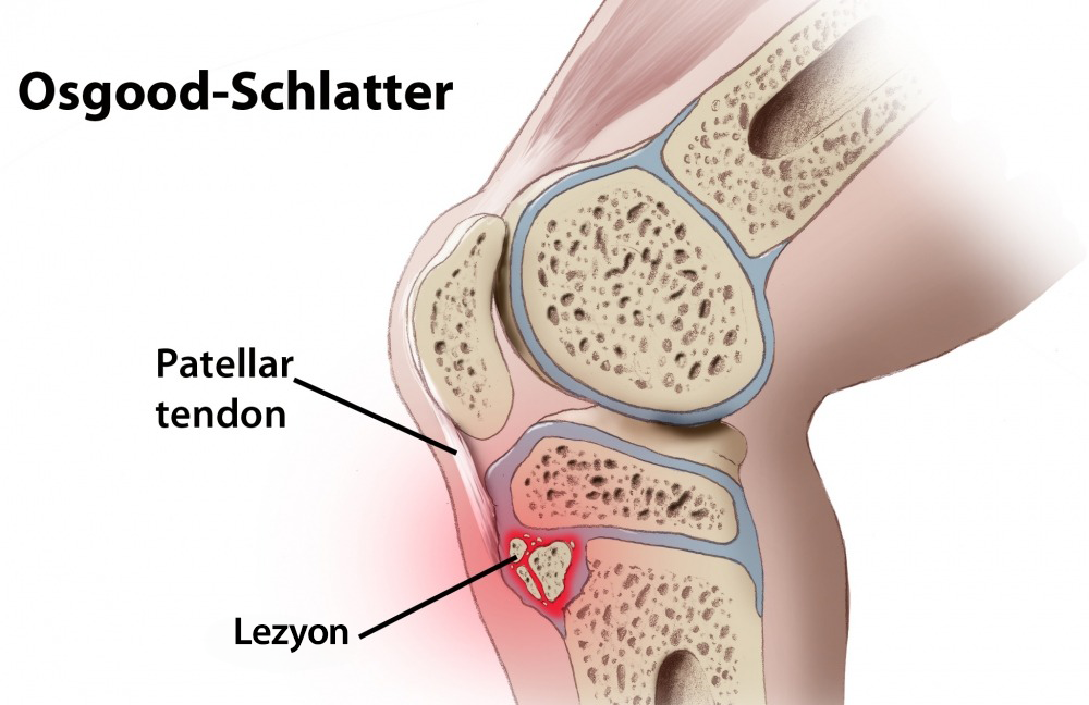 Osgood-Schlatter Hastalığı 