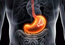 Gastrit Nedir ?