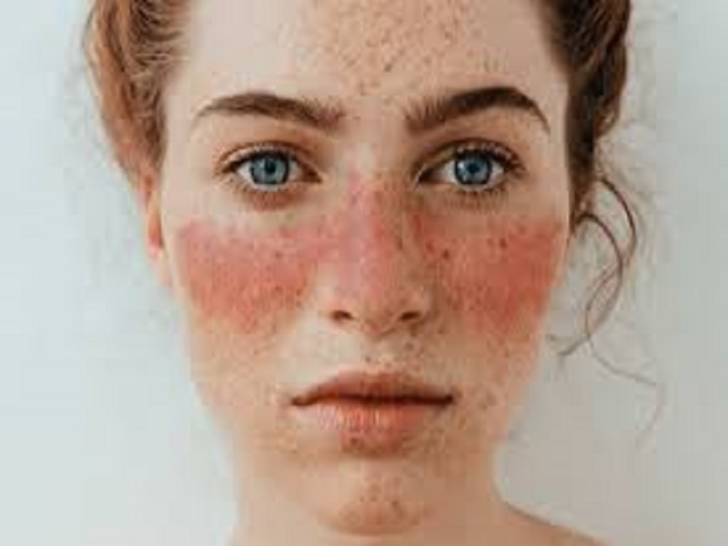 Kelebek Hastalığı (Lupus) Nedir