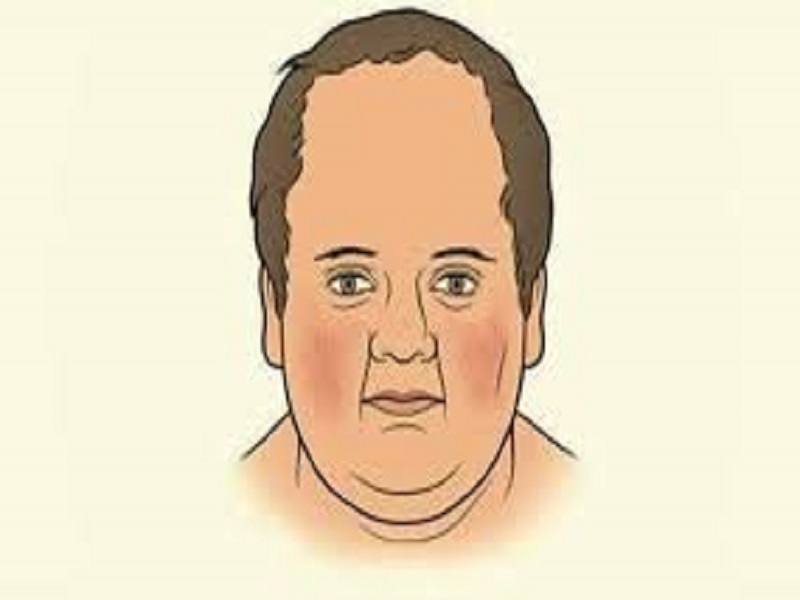 Cushing Sendromu Nedir?